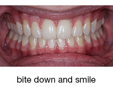 bite down and smile