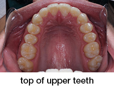 top of upper teeth