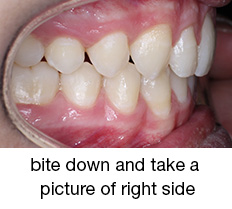 bite down and take a picture of right side