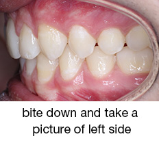 bite down and take a picture of left side